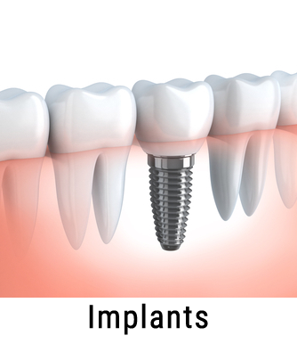 dental implants south holland